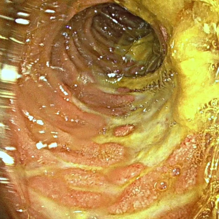 Maladie de Crohn : ulcérations de la paroi de l'intestin.