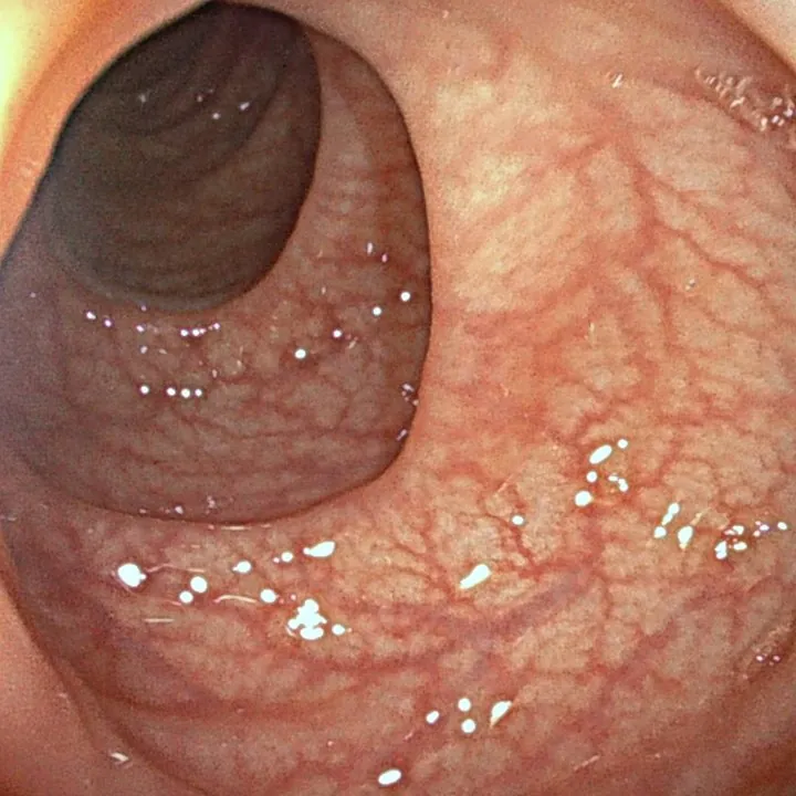 Côlon bien préparé en coloscopie : paroi propre et réseau vasculaire visible